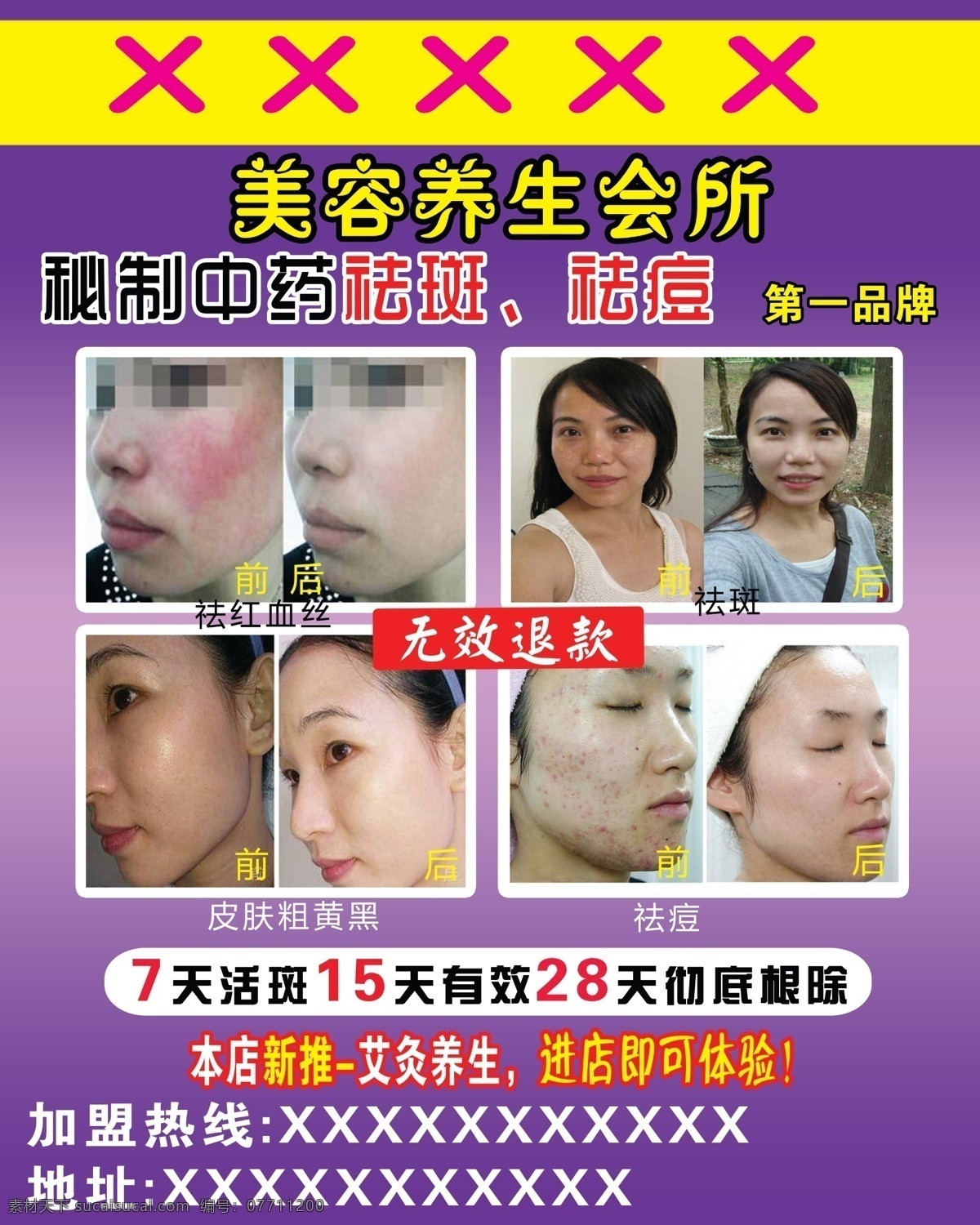 美容養(yǎng)生 祛斑圖片 祛痘圖片 祛斑 祛痘 前后 對(duì)比 使用 產(chǎn)品 比較