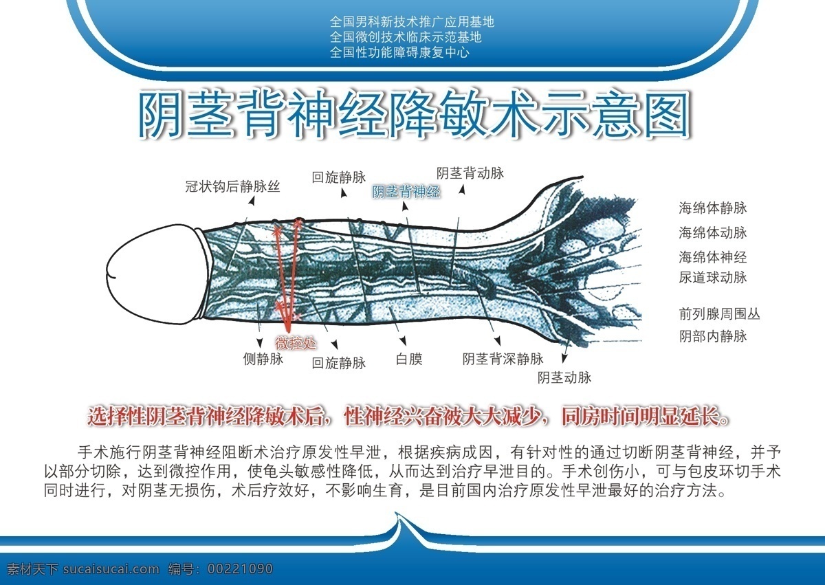 阴茎 背 神经 降 敏 术 示意图 背神经 清楚 白色