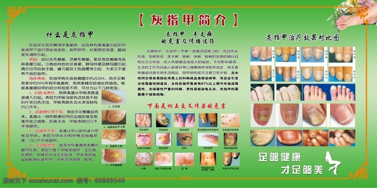 灰指甲 简介 灰指甲简介 指甲图 手灰指甲图 脚灰指甲图 治疗向导图 各种灰指甲图 名片卡片