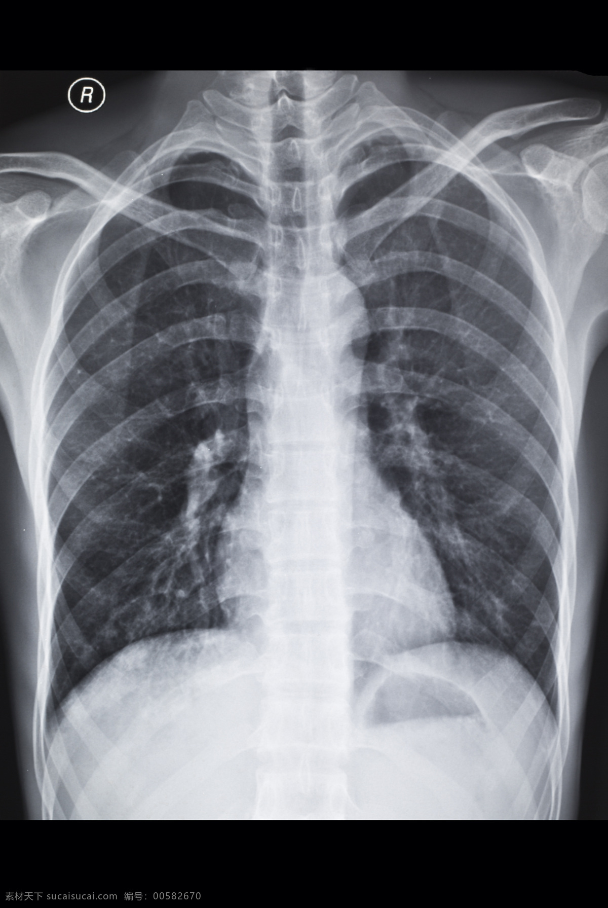 x光底片 x射线 骨骼 胸部扫描 底片 x射线扫描 医院 医疗 医学 病人 医疗护理 现代科技