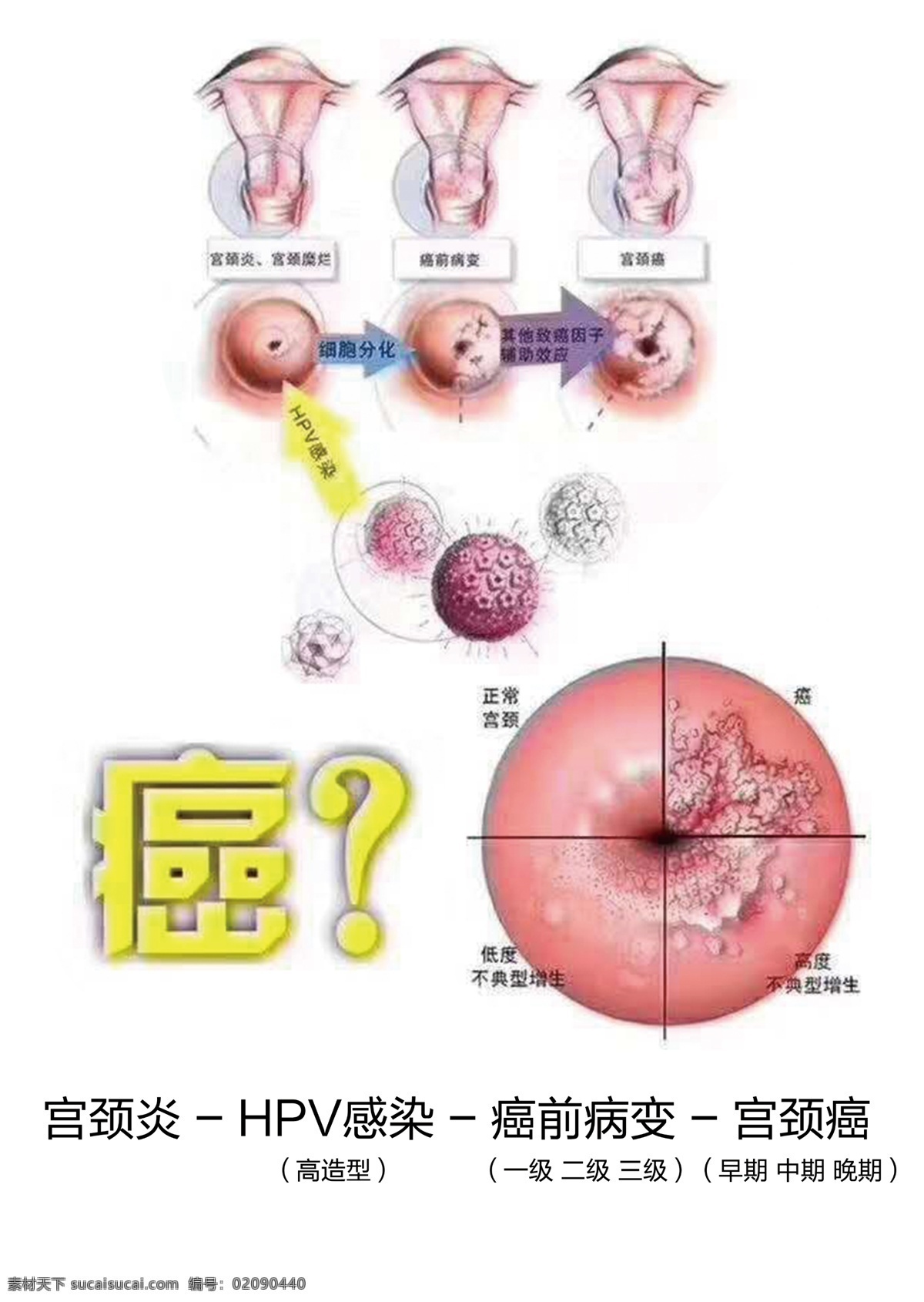 宫颈癌 子宫 癌症 病变 宫颈炎