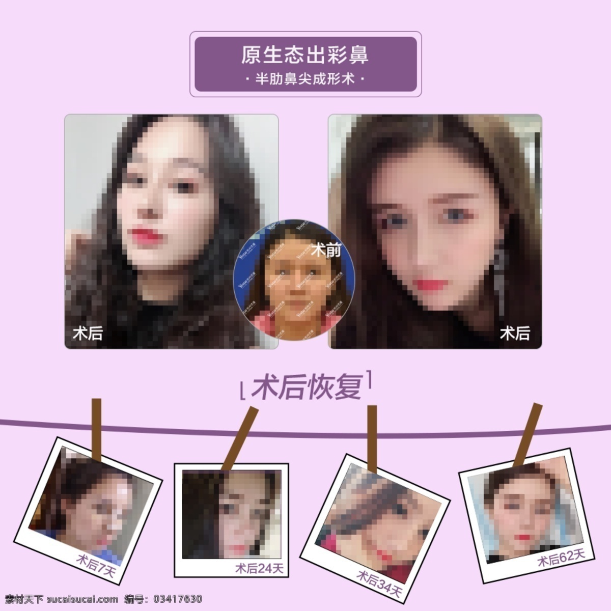 整形 案例 对比 图 医美 祛痘 眼袋 术前 术后 手术 鼻子 隆鼻 脱毛 医疗美容