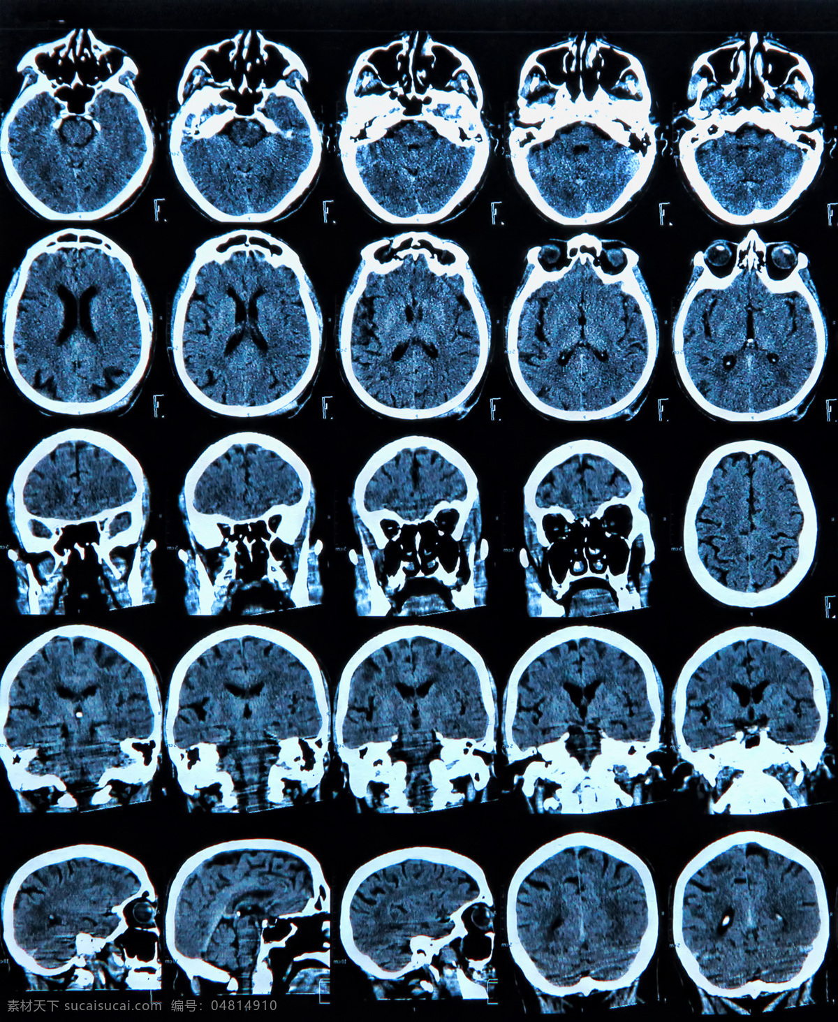 x光片 大脑 头部 x光 透视 医疗 ct 核磁共振 医疗护理 现代科技
