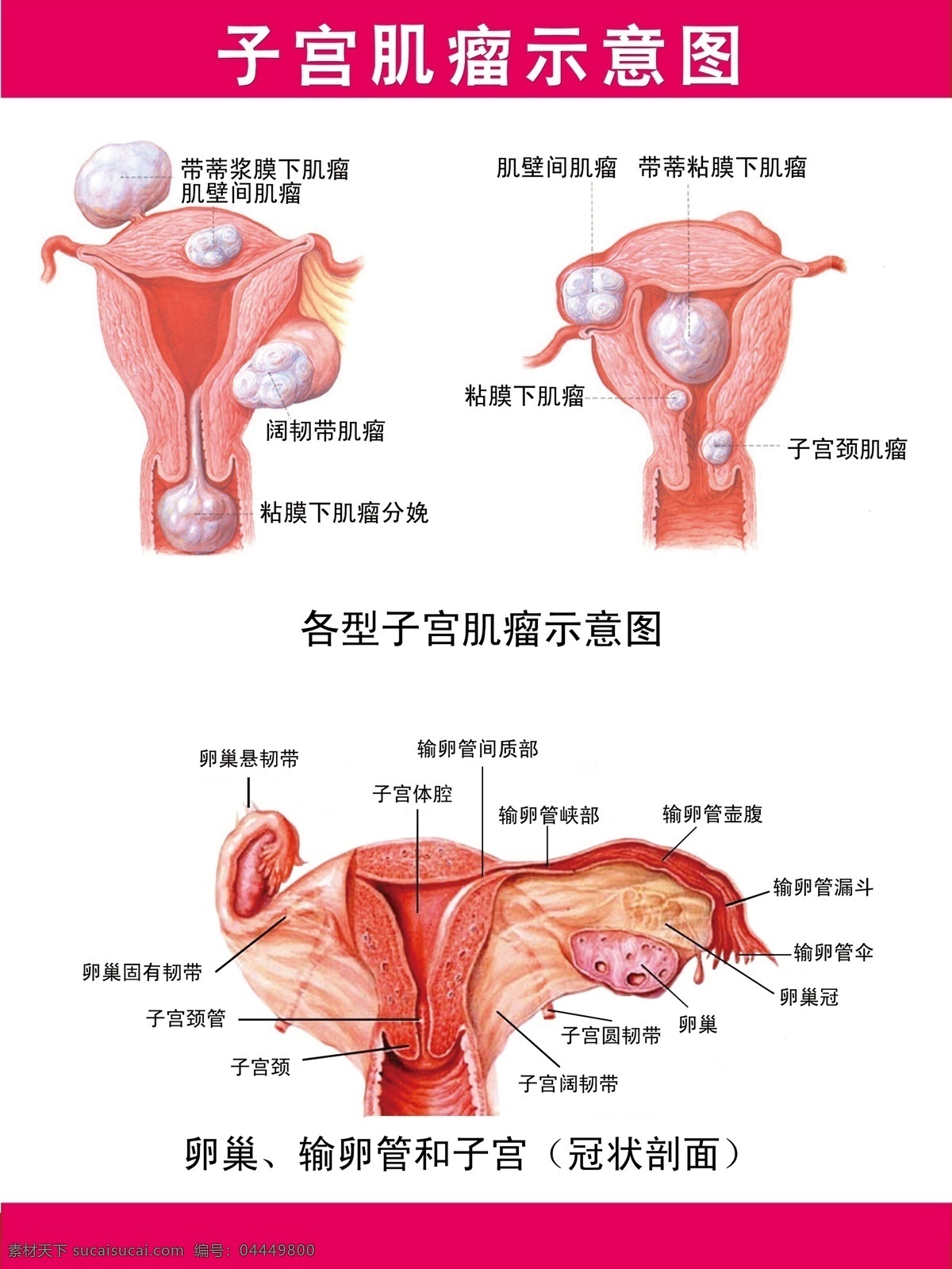 子宫肌瘤挂图 子宫肌瘤 肌瘤 子宫 示意图 展架 生活百科 医疗保健