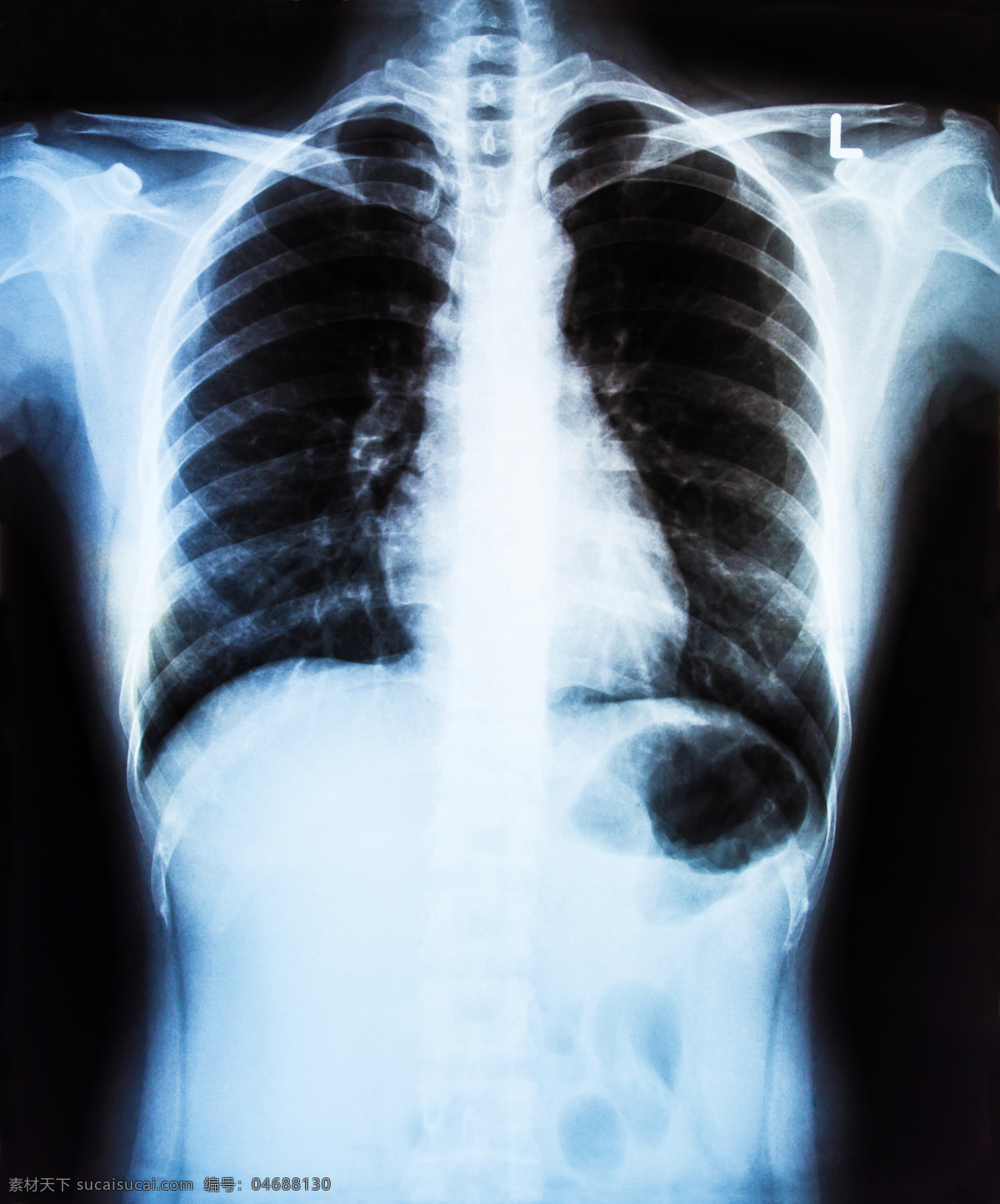 x射线 肺部扫描 底片 x光底片 x射线扫描 医院 医疗 医学 病人 医疗护理 现代科技