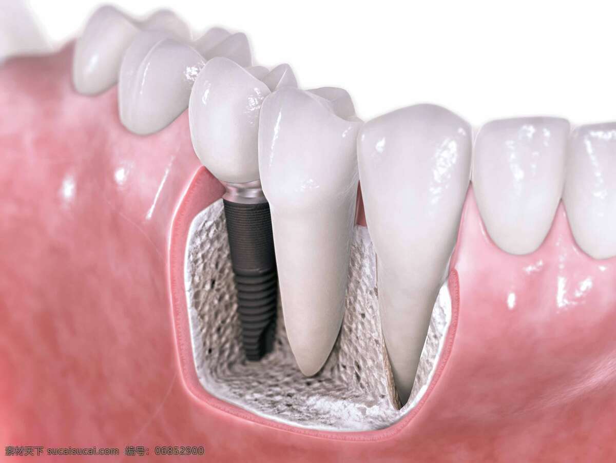 种牙 牙齿植入 人工牙根植入 瓷牙 牙根 牙冠 解构图 牙床 生活百科 医疗保健