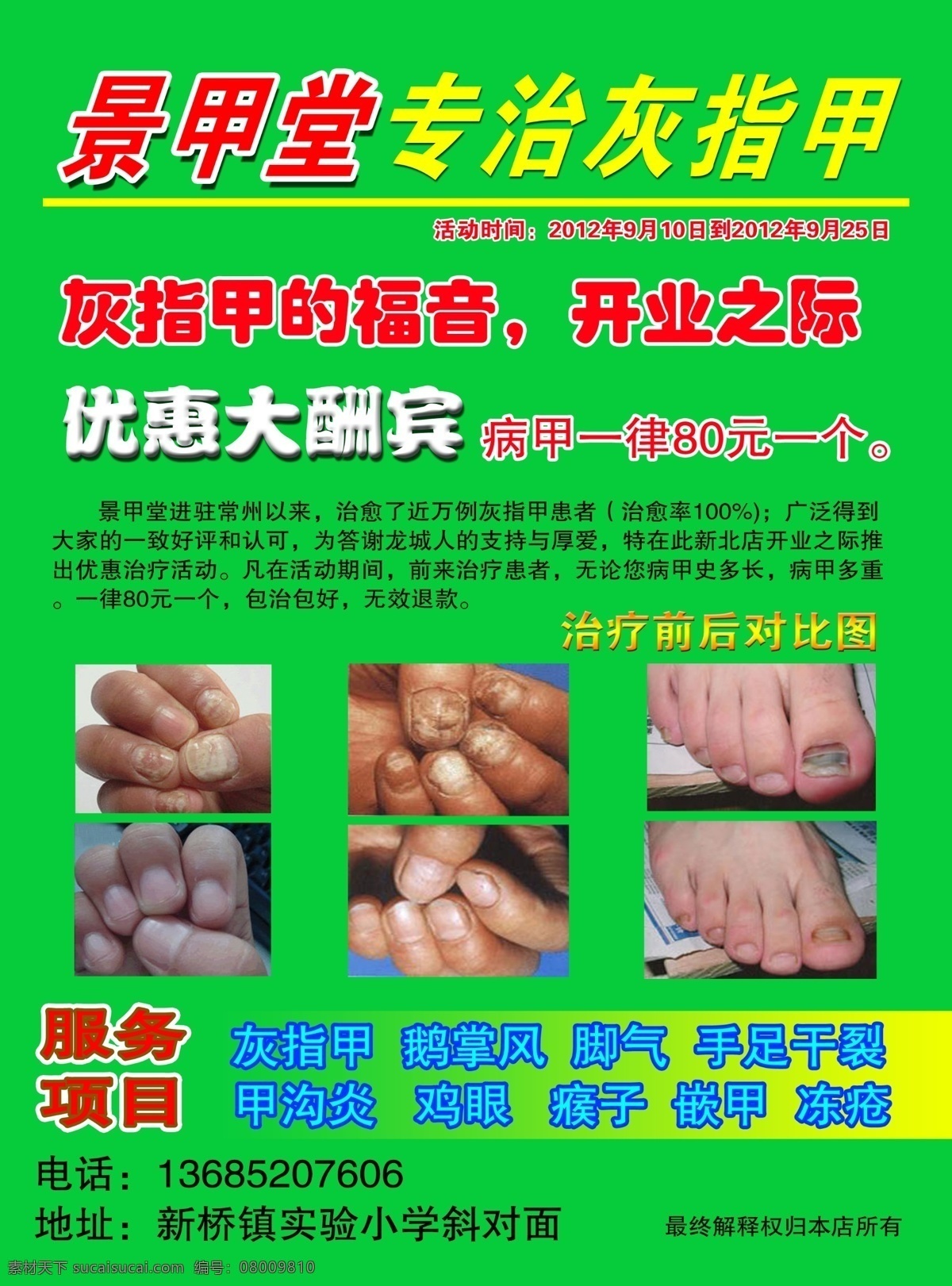 灰指甲宣传 景甲堂灰指甲 灰指甲治疗 灰指甲宣传单 鹅掌风 脚气 手足干裂 甲沟炎 鸡眼 瘊子 冻疮治疗 广告设计模板 源文件