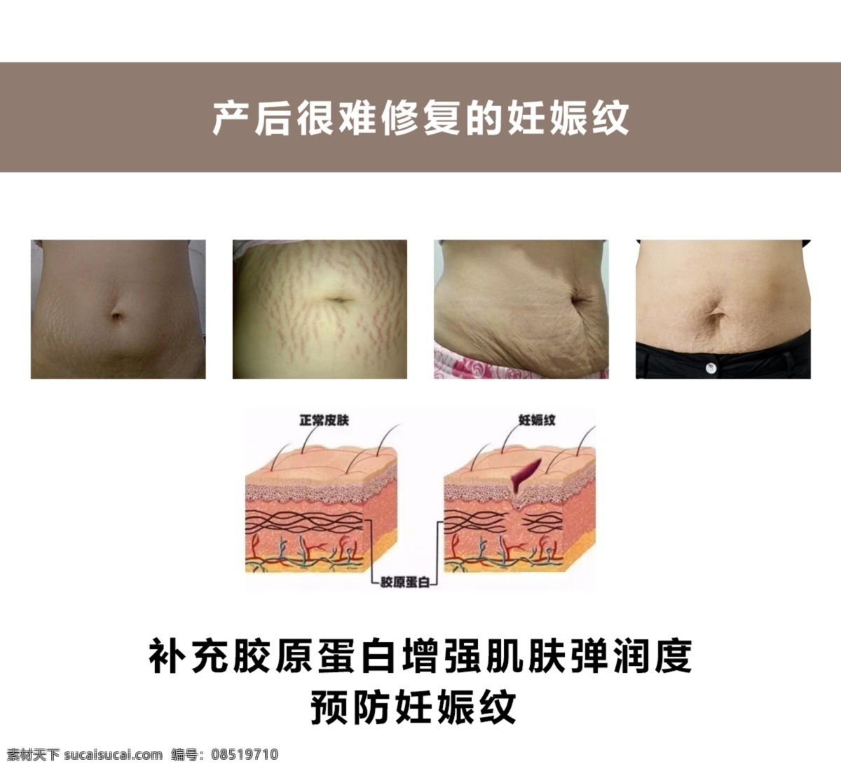 妊娠纹 产后 修复 胶原蛋白 弹性 肌底能力