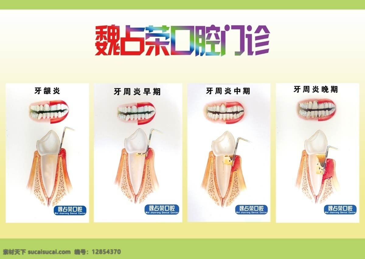 口腔门诊 牙龈 牙周炎 牙齿 健康 保护 分层