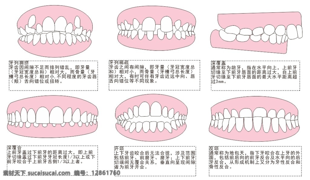 口腔 牙齿 畸形 图 牙齿畸形图 六种矫正图 口腔正畸图 矫正图示 牙齿正畸