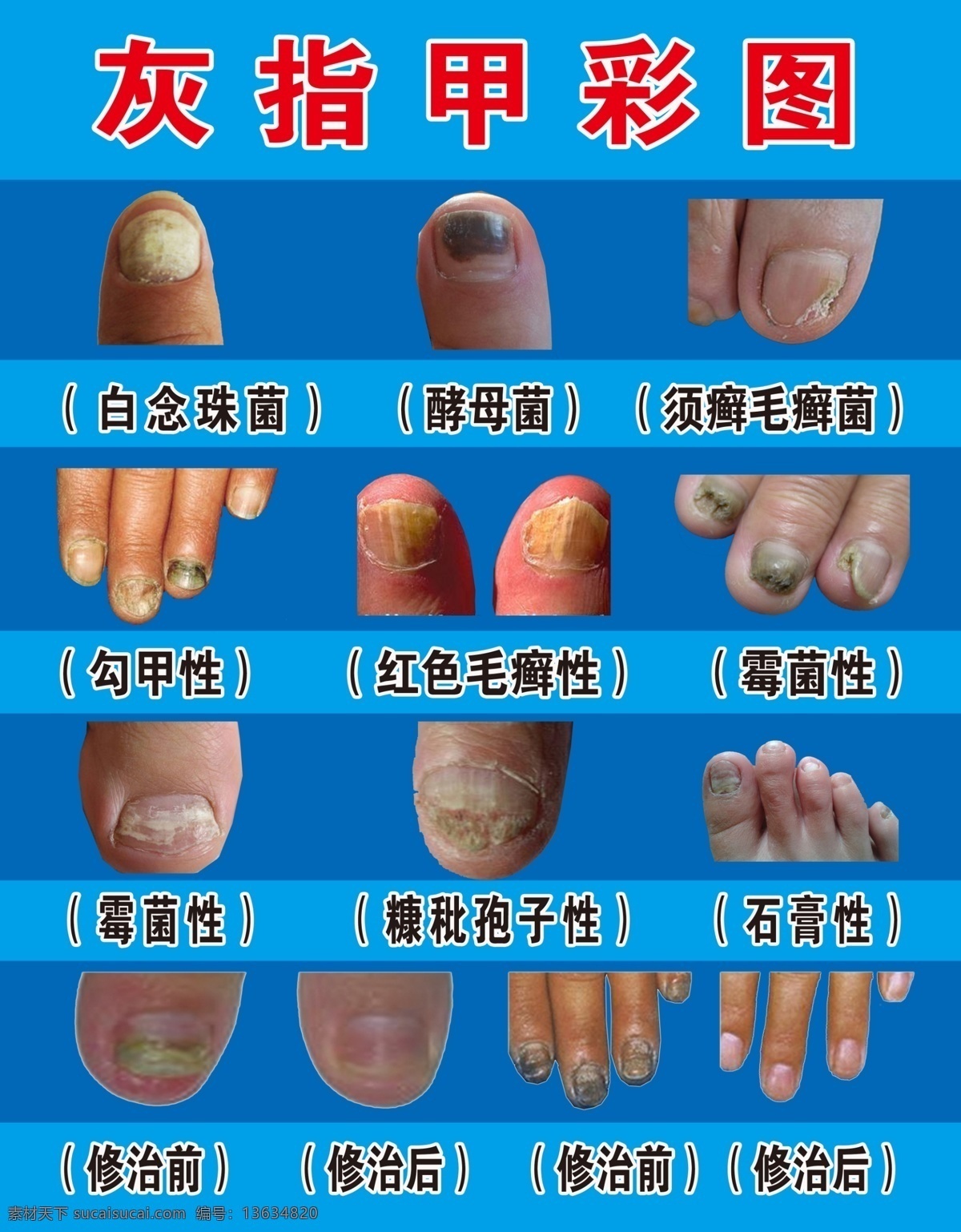 灰指甲彩图 灰指甲 彩图 甲沟炎 炎症 治疗前后