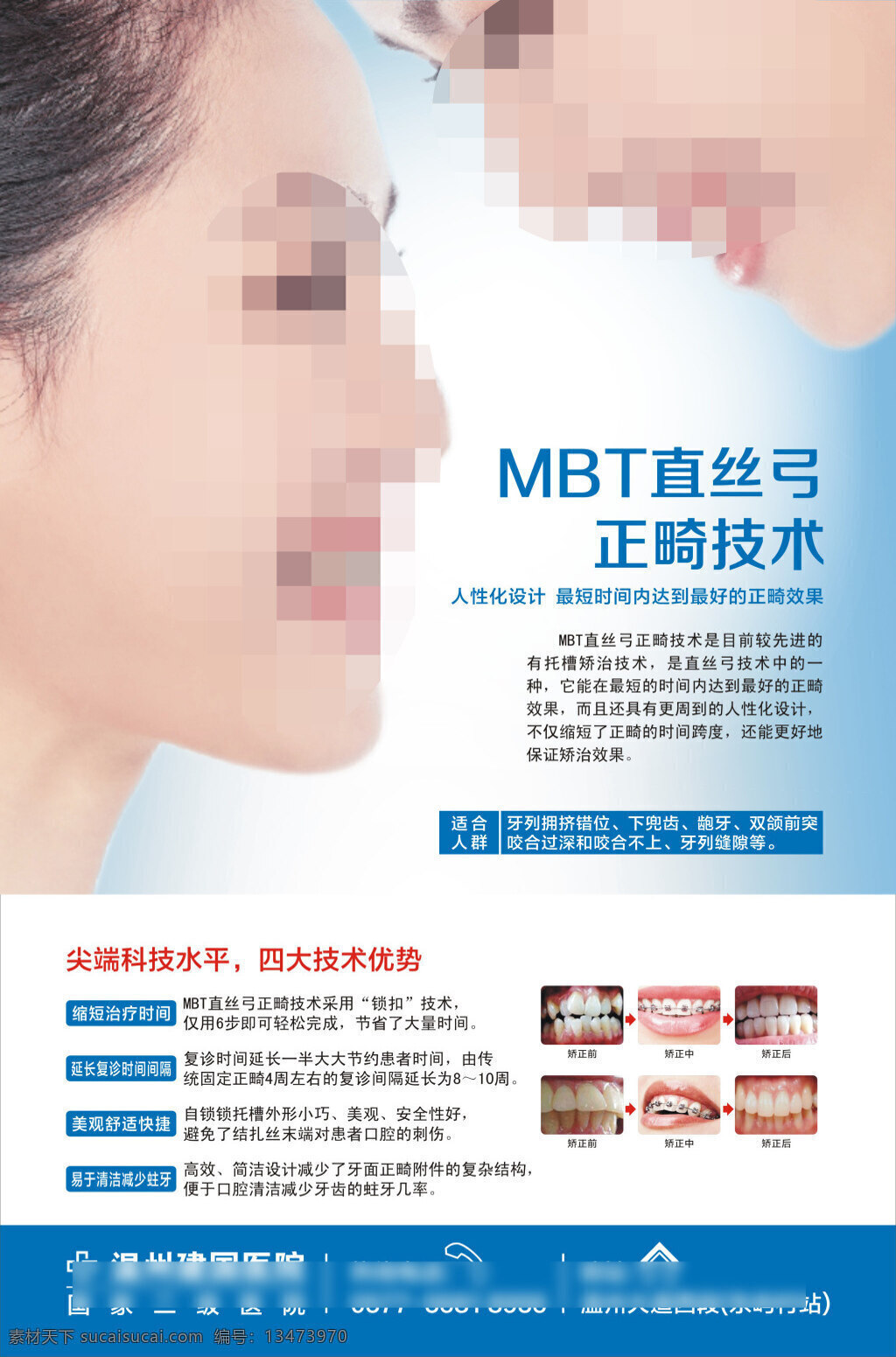 mbt 直 丝 弓 正畸 技术 展板 正畸技术展板