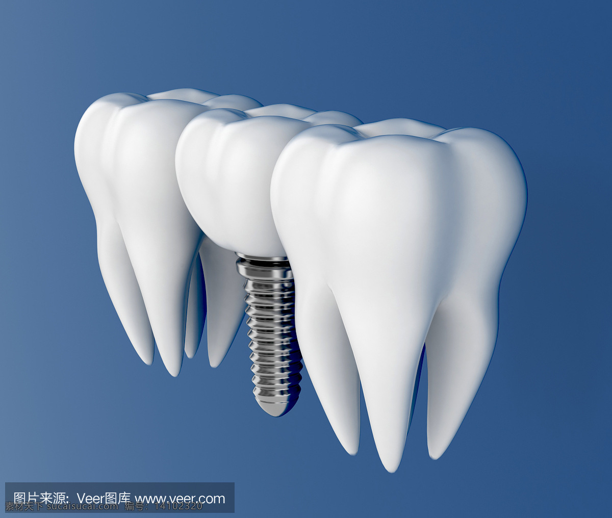 种植牙图片 种植 牙齿 白色 种植体 模型 生活百科 医疗保健